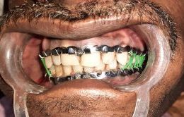 Mandidulomaxillary Fixation