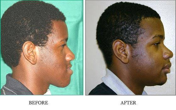 Orthognatic Surgery